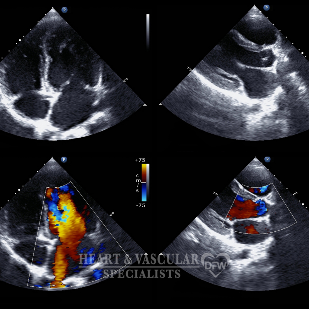 Echocardiography Imaging
