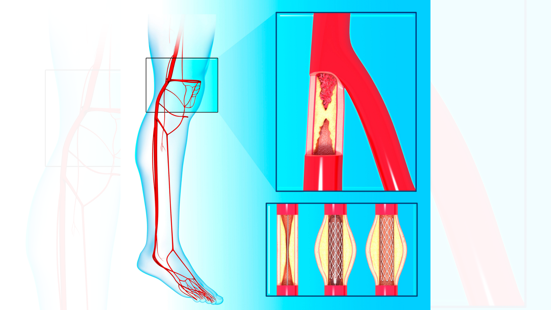 peripheral artery disease treatment options